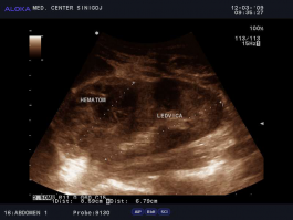 Ultrazvok ledvic - hematom v ledvici